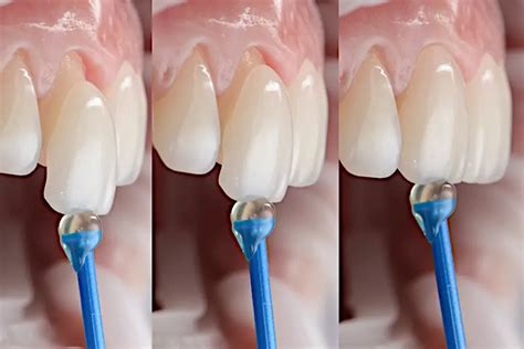 Procedimiento de veneer directo con composite