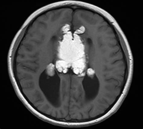 Imagen de resonancia magnética de un lipoma del cuerpo calloso