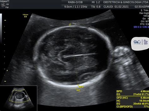 Ecografía mostrando la ausencia de latido cardíaco fetal