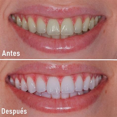 Gráfico comparativo de resultados de blanqueamiento dental