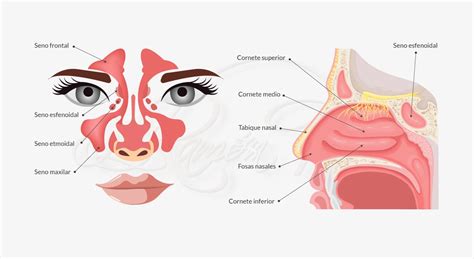 Ilustración médica mostrando la anatomía de la nariz y las causas comunes de hemorragia nasal