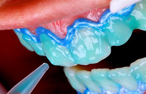 Ilustración del proceso de aplicación del gel blanqueador en la cubeta dental