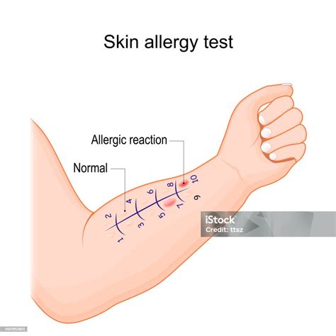 Ilustración del test de alergia cutánea